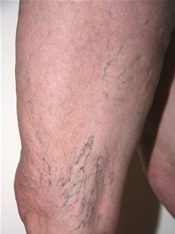 Spider Veins - Before Treatment