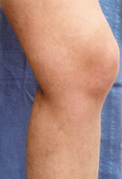 Varicose Veins - After Treatment